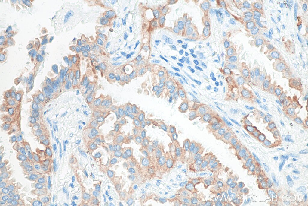 Immunohistochemistry (IHC) staining of human lung cancer tissue using Cytokeratin 7 Polyclonal antibody (15539-1-AP)