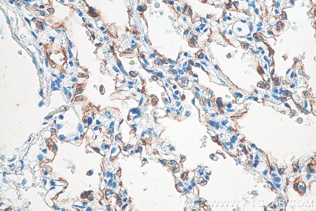 Immunohistochemistry (IHC) staining of human lung tissue using Cytokeratin 7 Polyclonal antibody (15539-1-AP)