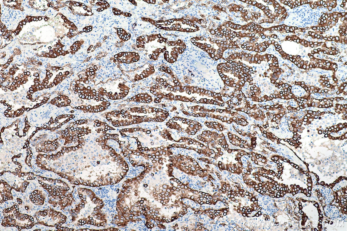 Immunohistochemistry (IHC) staining of human lung cancer tissue using Cytokeratin 7 Polyclonal antibody (15539-1-AP)