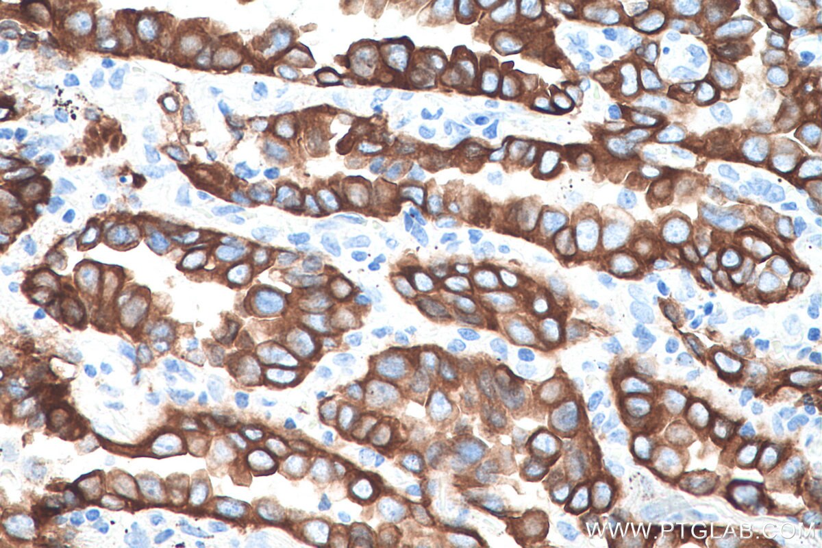 Immunohistochemistry (IHC) staining of human lung cancer tissue using Cytokeratin 7 Polyclonal antibody (15539-1-AP)