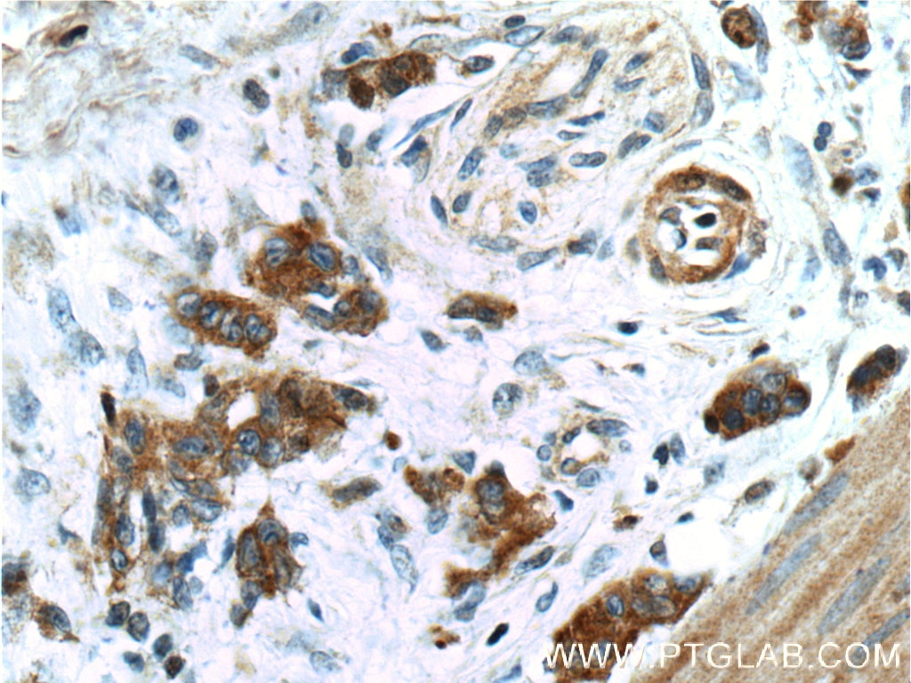 Immunohistochemistry (IHC) staining of human stomach cancer tissue using Cytokeratin 7 Polyclonal antibody (15539-1-AP)