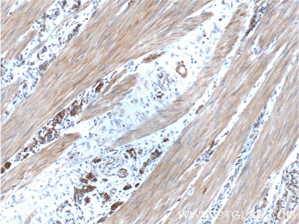 Immunohistochemistry (IHC) staining of human stomach cancer tissue using Cytokeratin 7 Polyclonal antibody (15539-1-AP)