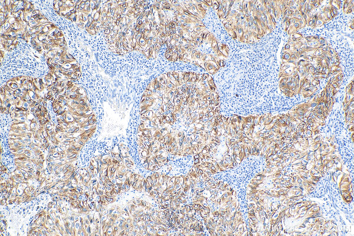 IHC staining of human lung cancer using 15539-1-AP