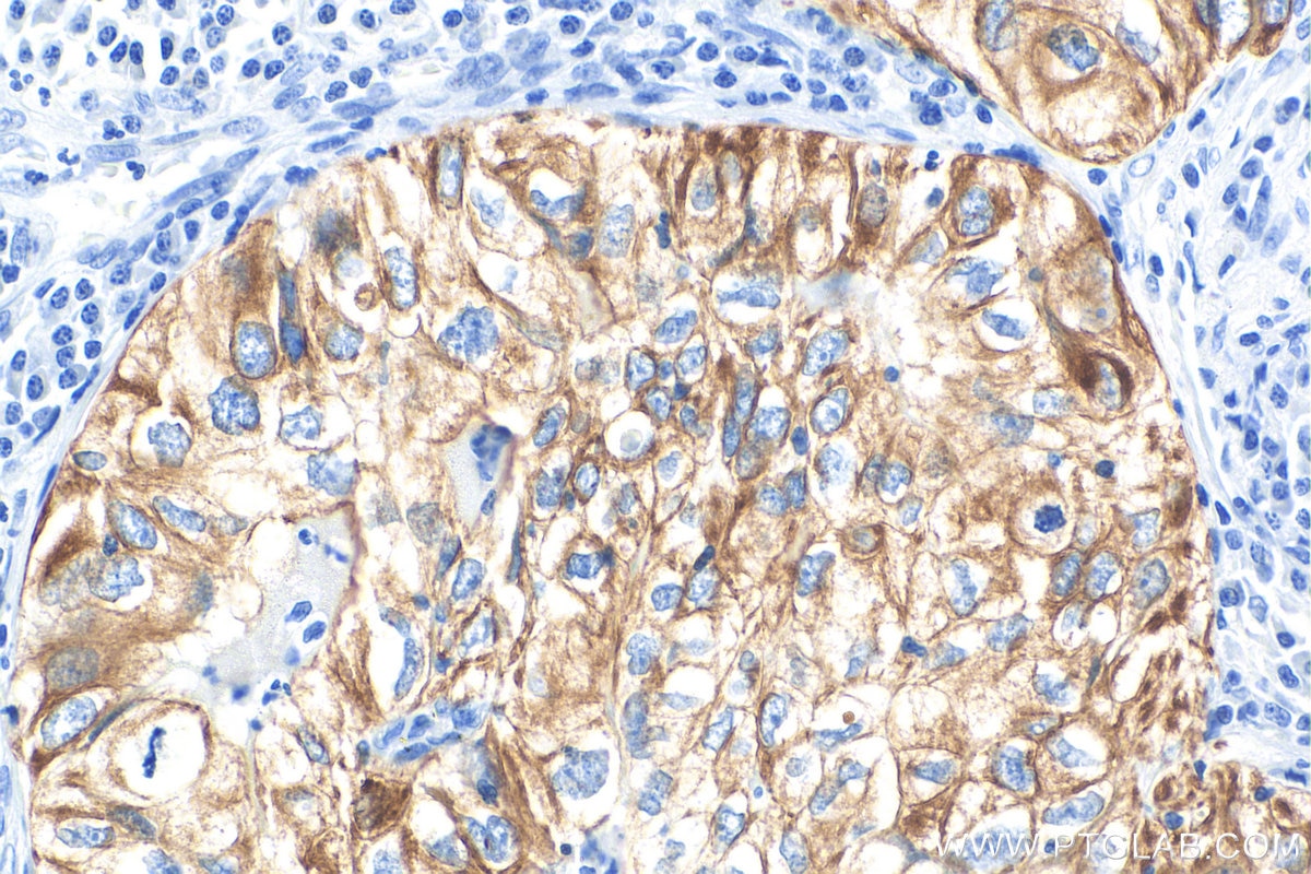 Immunohistochemistry (IHC) staining of human lung cancer tissue using Cytokeratin 7 Polyclonal antibody (15539-1-AP)
