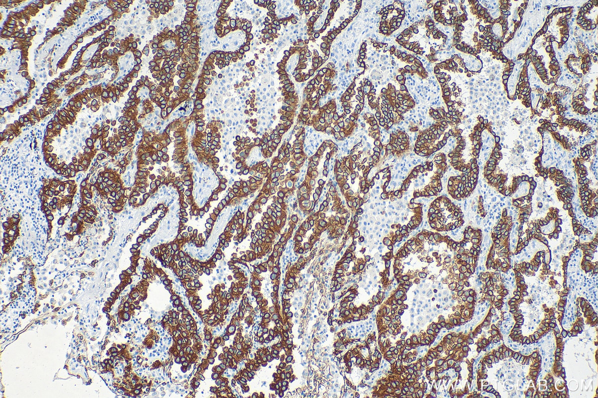 Immunohistochemistry (IHC) staining of human lung cancer tissue using Cytokeratin 7 Polyclonal antibody (15539-1-AP)