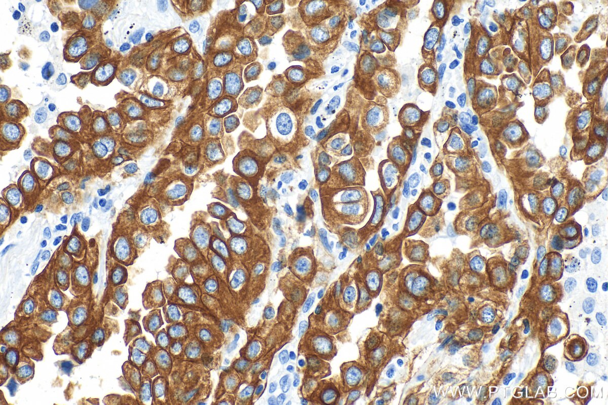 IHC staining of human lung cancer using 15539-1-AP