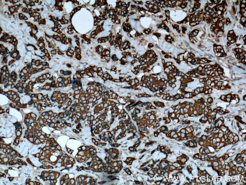 IHC staining of human breast cancer using 15539-1-AP