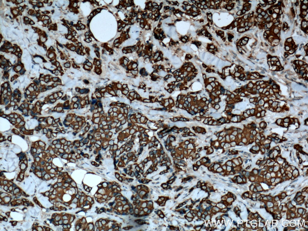 Immunohistochemistry (IHC) staining of human breast cancer tissue using Cytokeratin 7 Polyclonal antibody (15539-1-AP)