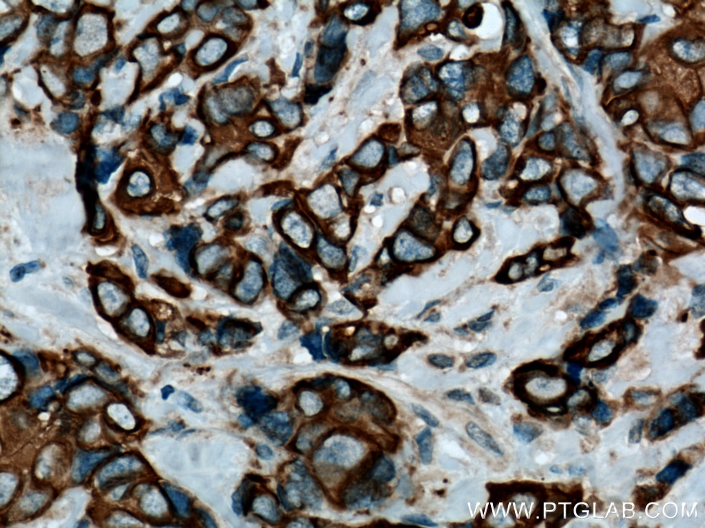 Immunohistochemistry (IHC) staining of human breast cancer tissue using Cytokeratin 7 Polyclonal antibody (15539-1-AP)