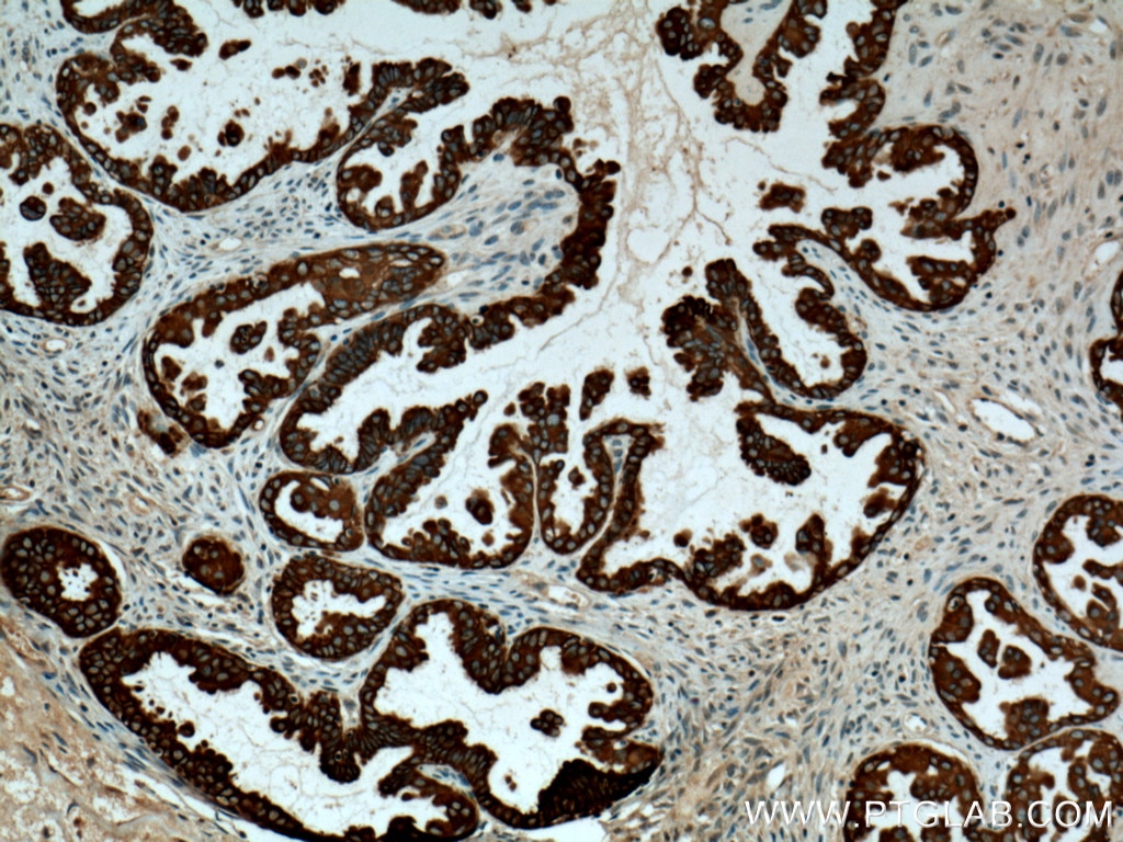 Immunohistochemistry (IHC) staining of human ovary tumor tissue using Cytokeratin 7 Polyclonal antibody (15539-1-AP)