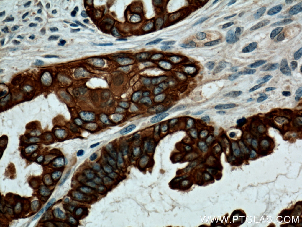IHC staining of human ovary tumor using 15539-1-AP