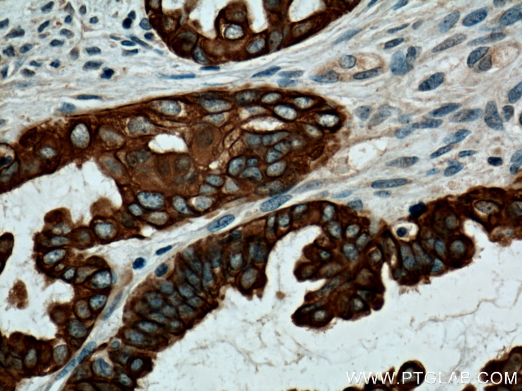 Immunohistochemistry (IHC) staining of human ovary tumor tissue using Cytokeratin 7 Polyclonal antibody (15539-1-AP)