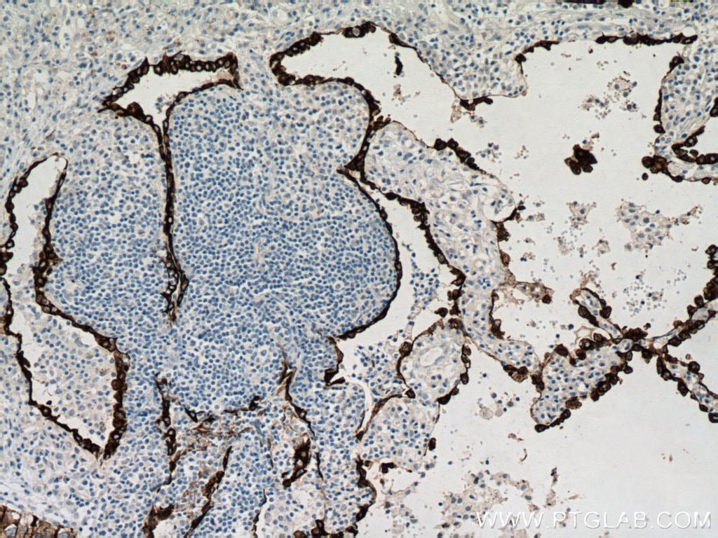 IHC staining of human lung cancer using 22208-1-AP