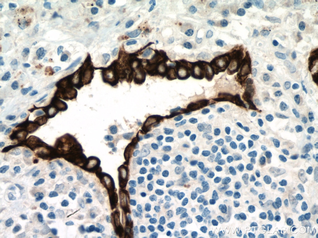 Immunohistochemistry (IHC) staining of human lung cancer tissue using Cytokeratin 7 Polyclonal antibody (22208-1-AP)