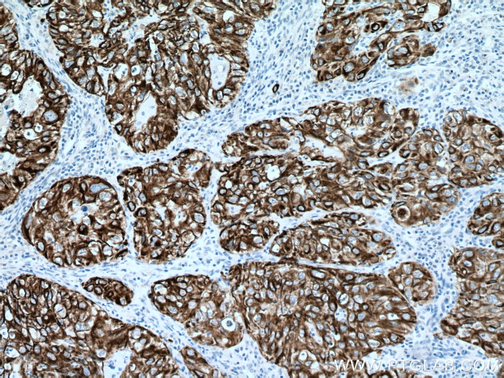 Immunohistochemistry (IHC) staining of human lung cancer tissue using Cytokeratin 7 Polyclonal antibody (22208-1-AP)