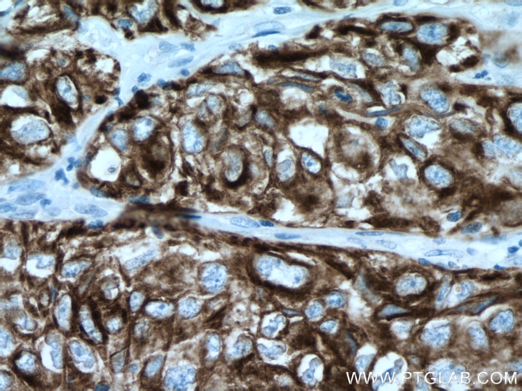 Immunohistochemistry (IHC) staining of human lung cancer tissue using Cytokeratin 7 Polyclonal antibody (22208-1-AP)