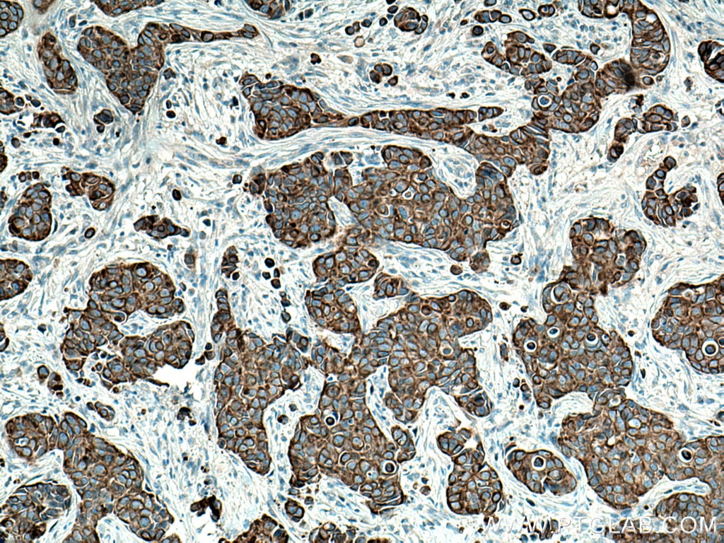 Immunohistochemistry (IHC) staining of human breast cancer tissue using Cytokeratin 7 Polyclonal antibody (22208-1-AP)