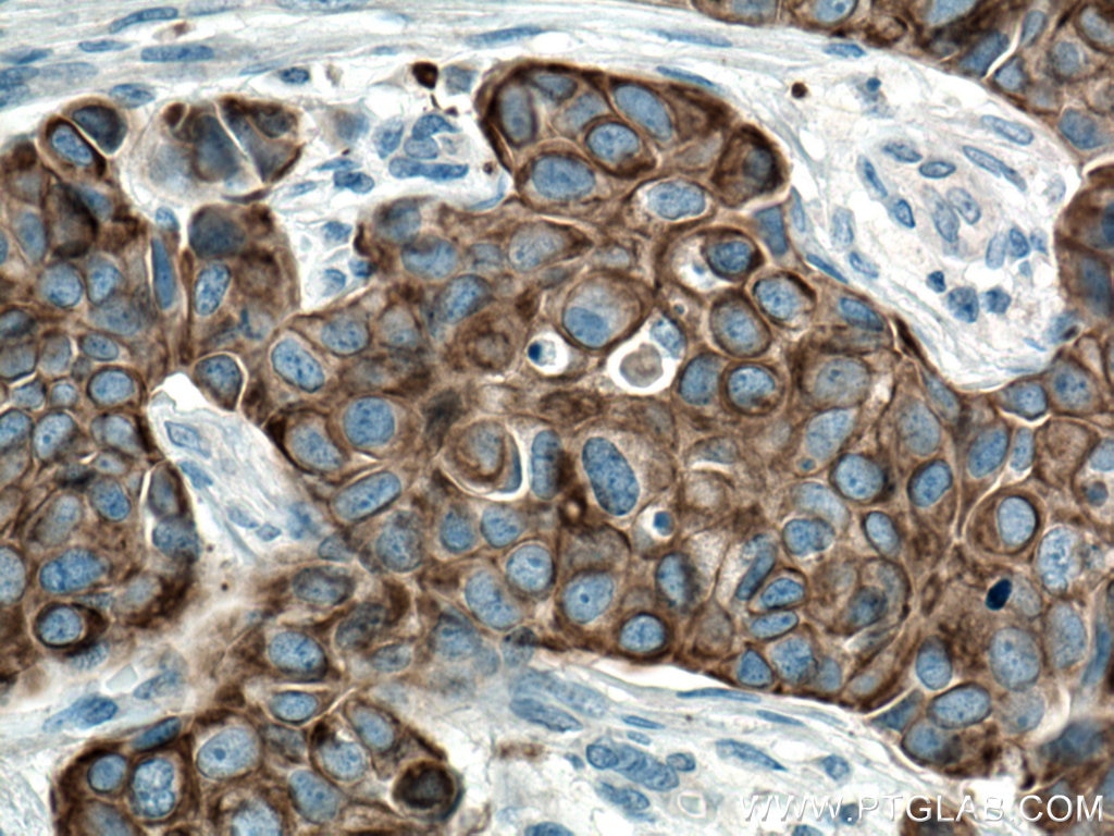 Immunohistochemistry (IHC) staining of human breast cancer tissue using Cytokeratin 7 Polyclonal antibody (22208-1-AP)