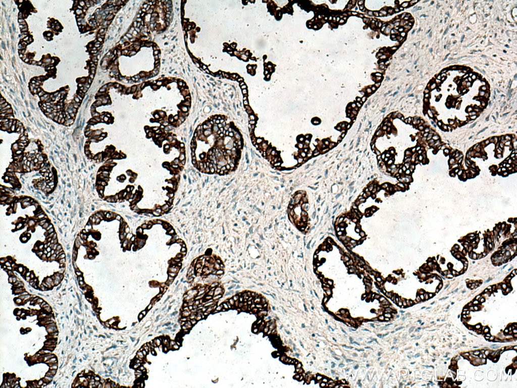 IHC staining of human ovary tumor using 22208-1-AP