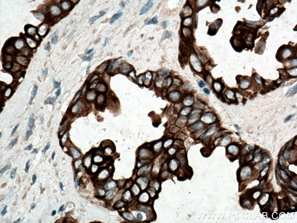 Immunohistochemistry (IHC) staining of human ovary tumor tissue using Cytokeratin 7 Polyclonal antibody (22208-1-AP)