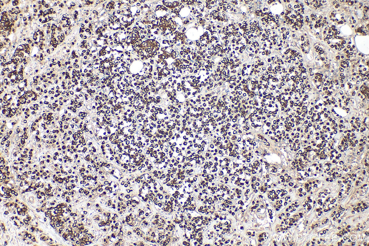 Immunohistochemistry (IHC) staining of human breast cancer tissue using Cytokeratin 7 Polyclonal antibody (22208-1-AP)