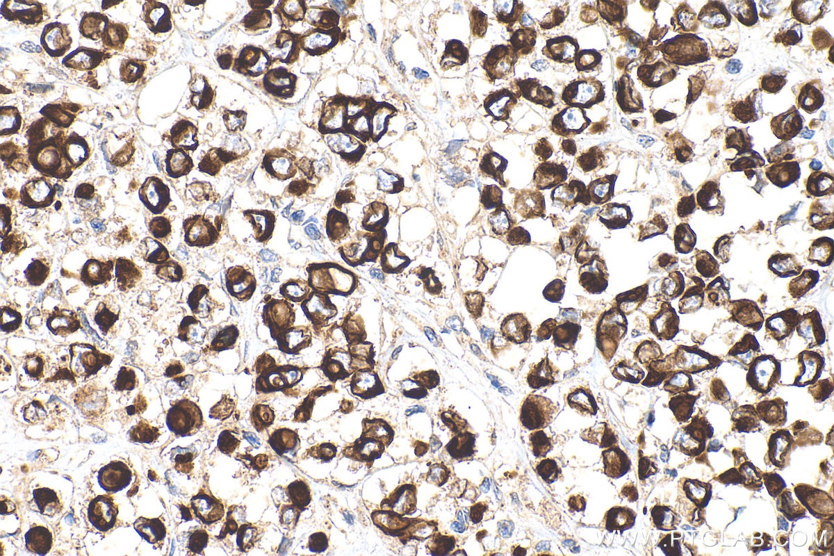 Immunohistochemistry (IHC) staining of human breast cancer tissue using Cytokeratin 7 Polyclonal antibody (22208-1-AP)