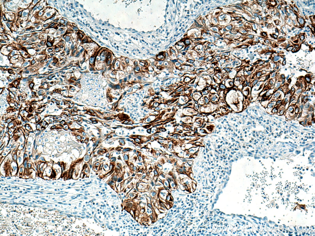 Immunohistochemistry (IHC) staining of human lung cancer tissue using Cytokeratin 7-specific Polyclonal antibody (17513-1-AP)