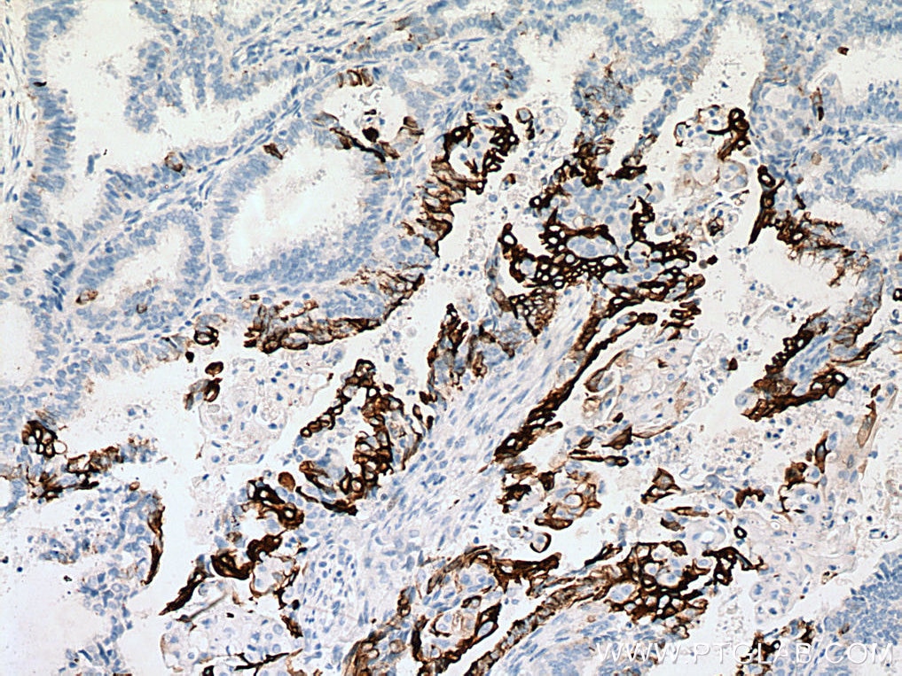 Immunohistochemistry (IHC) staining of human ovary tumor tissue using Cytokeratin 7-specific Polyclonal antibody (17513-1-AP)