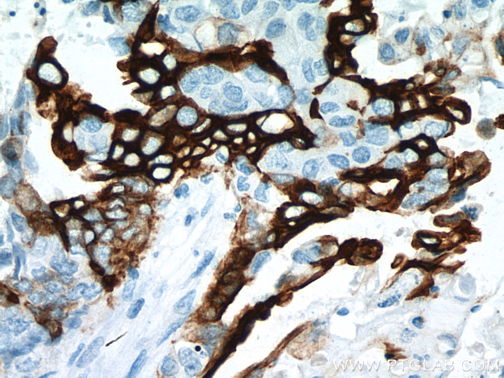 Immunohistochemistry (IHC) staining of human ovary tumor tissue using Cytokeratin 7-specific Polyclonal antibody (17513-1-AP)