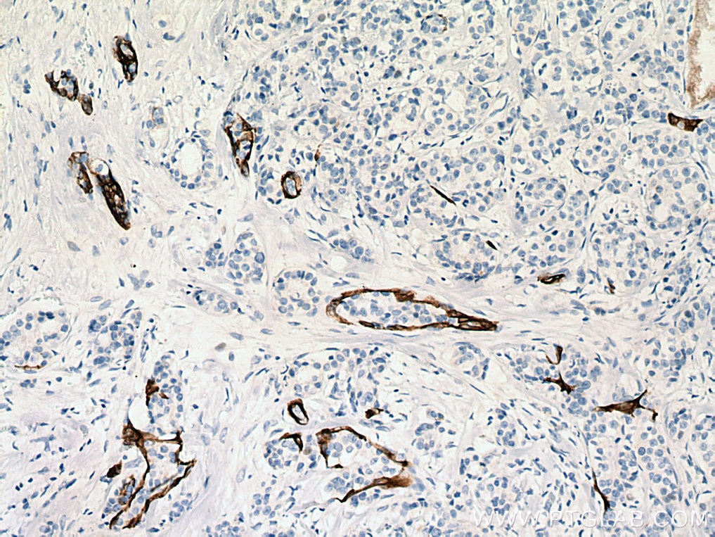 Immunohistochemistry (IHC) staining of human breast cancer tissue using Cytokeratin 7-specific Polyclonal antibody (17513-1-AP)