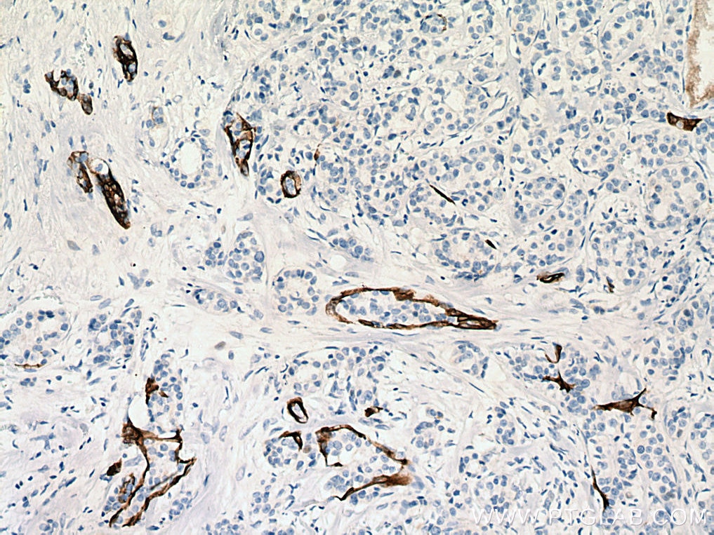 IHC staining of human breast cancer using 17513-1-AP