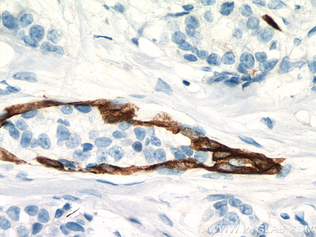 Immunohistochemistry (IHC) staining of human breast cancer tissue using Cytokeratin 7-specific Polyclonal antibody (17513-1-AP)