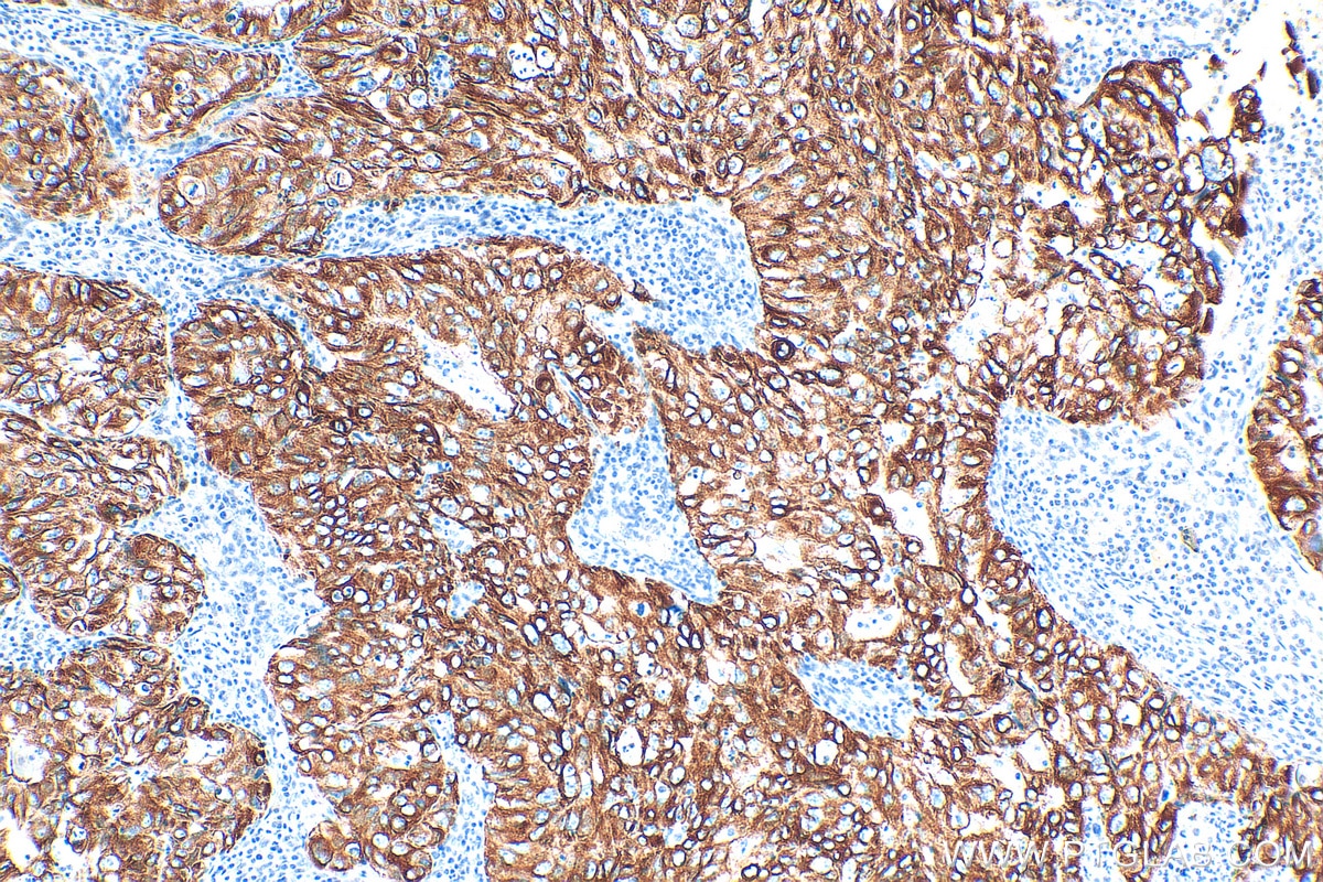 IHC staining of human lung cancer using 17513-1-AP