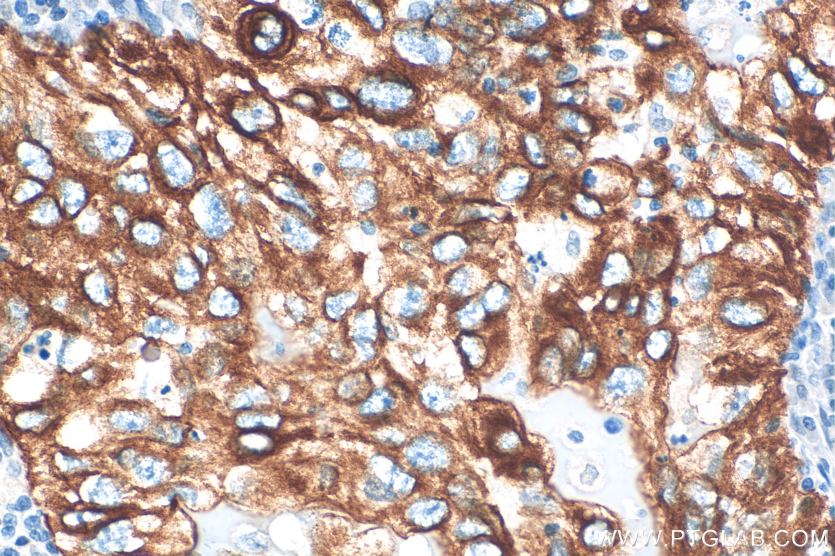 Immunohistochemistry (IHC) staining of human lung cancer tissue using Cytokeratin 7-specific Polyclonal antibody (17513-1-AP)