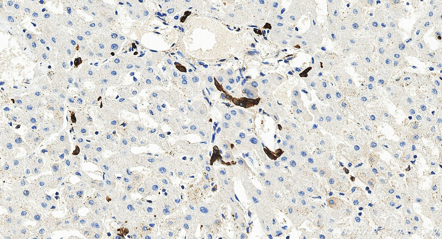 IHC staining of human liver using 17513-1-AP Immunohistochemistry (IHC) staining of human liver tissue using Cytokeratin 7-specific Polyclonal antibody (17513-1-AP)