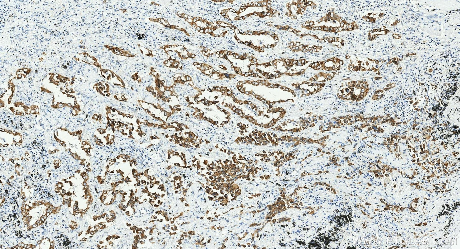 IHC staining of human lung cancer using 17513-1-AP Immunohistochemistry (IHC) staining of human lung cancer tissue using Cytokeratin 7-specific Polyclonal antibody (17513-1-AP)