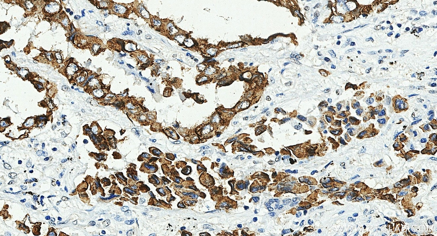 IHC staining of human lung cancer using 17513-1-AP Immunohistochemistry (IHC) staining of human lung cancer tissue using Cytokeratin 7-specific Polyclonal antibody (17513-1-AP)
