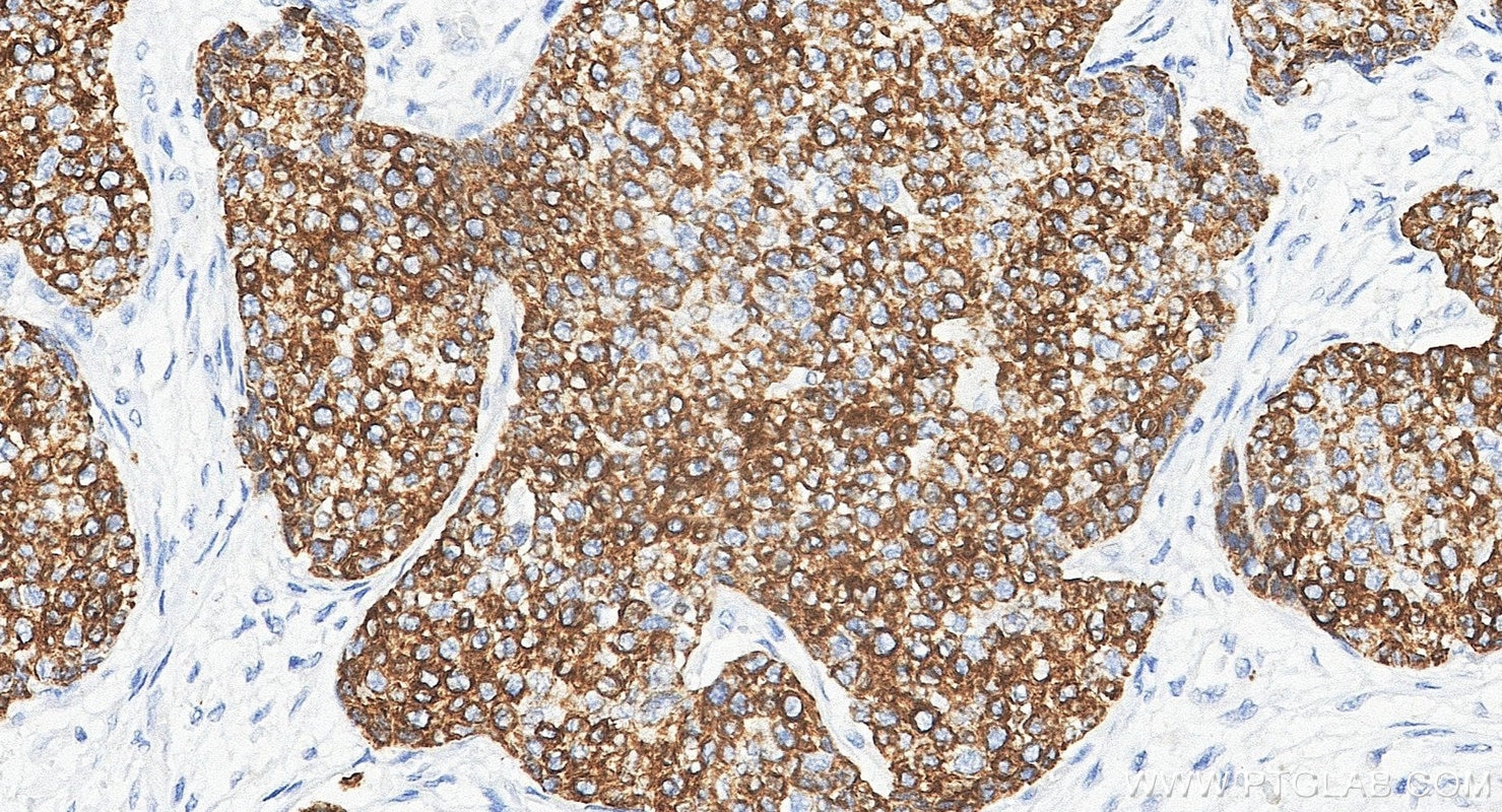 Immunohistochemistry (IHC) staining of human breast cancer tissue using Cytokeratin 7-specific Polyclonal antibody (17513-1-AP)