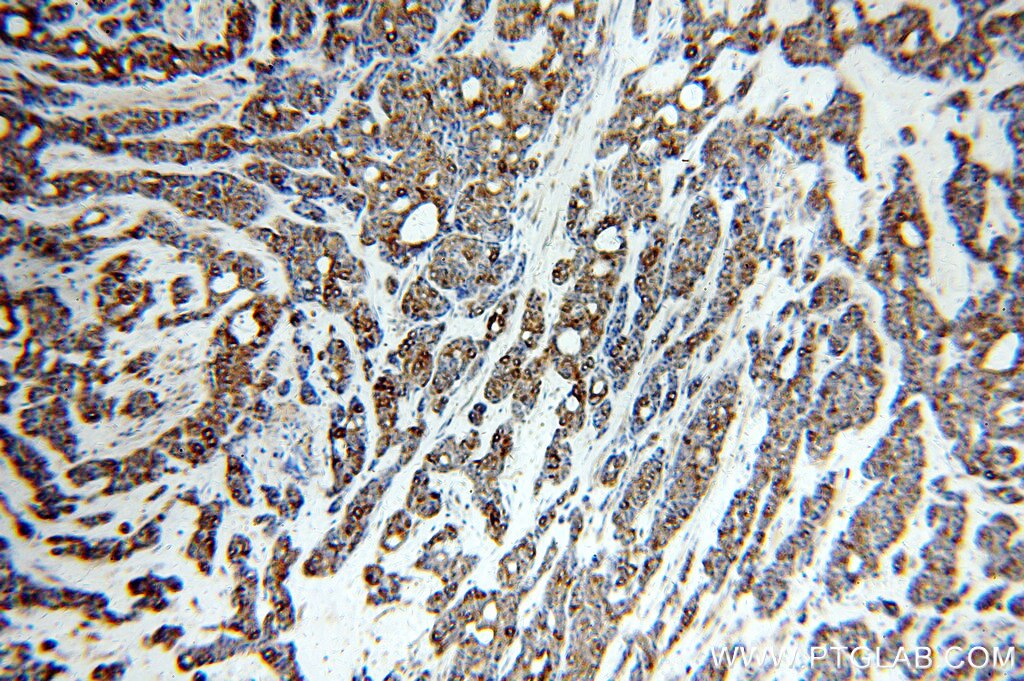 Immunohistochemistry (IHC) staining of human cervical cancer tissue using Cytokeratin 7-specific Polyclonal antibody (17513-1-AP)