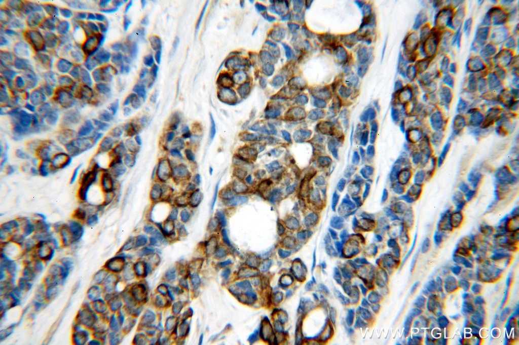 Immunohistochemistry (IHC) staining of human cervical cancer tissue using Cytokeratin 7-specific Polyclonal antibody (17513-1-AP)