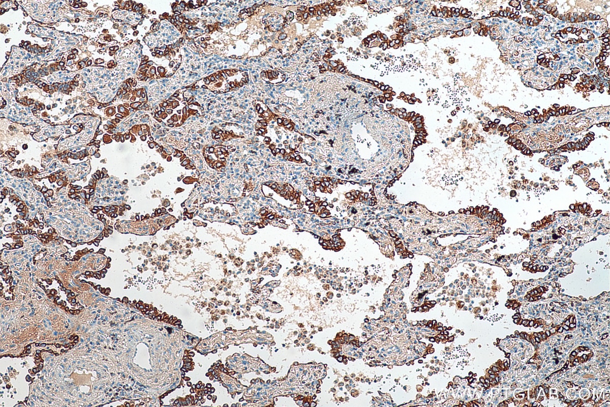 Immunohistochemistry (IHC) staining of human lung cancer tissue using Cytokeratin 7-specific Polyclonal antibody (16857-1-AP)