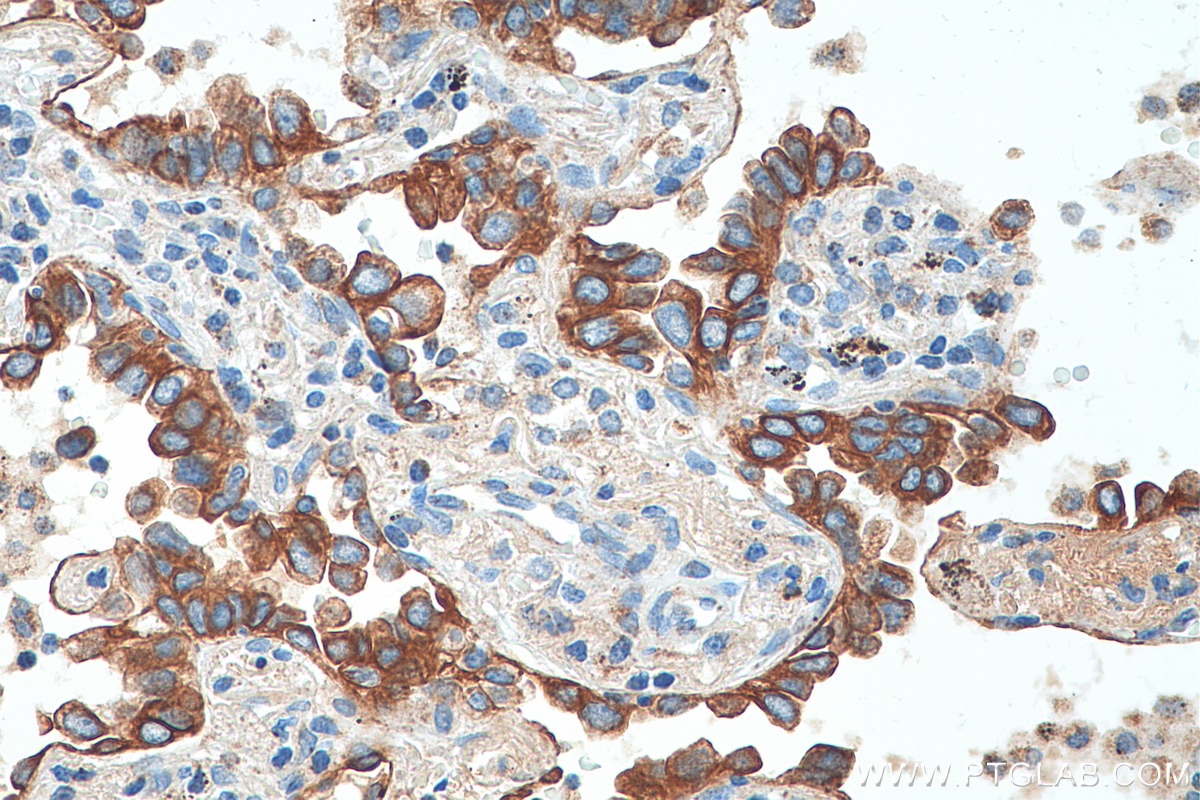 Immunohistochemistry (IHC) staining of human lung cancer tissue using Cytokeratin 7-specific Polyclonal antibody (16857-1-AP)