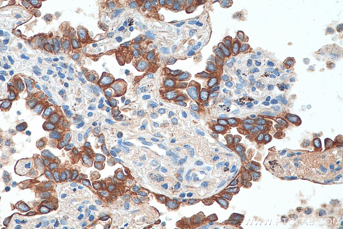 IHC staining of human lung cancer using 16857-1-AP