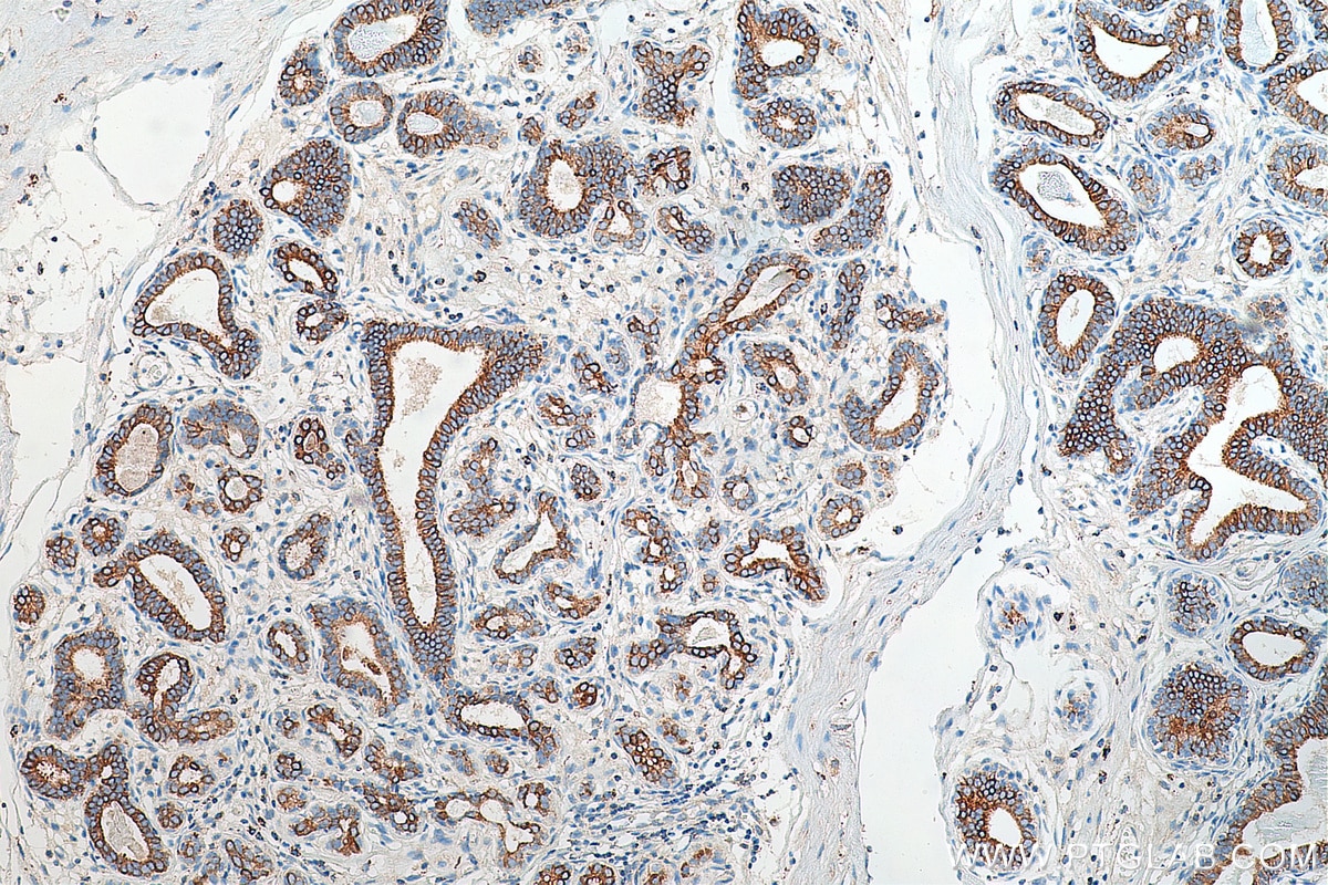 IHC staining of human breast cancer using 16857-1-AP