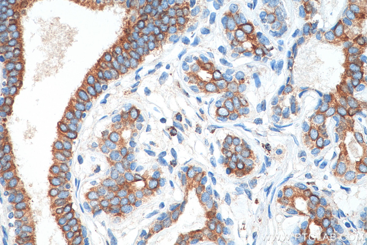 Immunohistochemistry (IHC) staining of human breast cancer tissue using Cytokeratin 7-specific Polyclonal antibody (16857-1-AP)