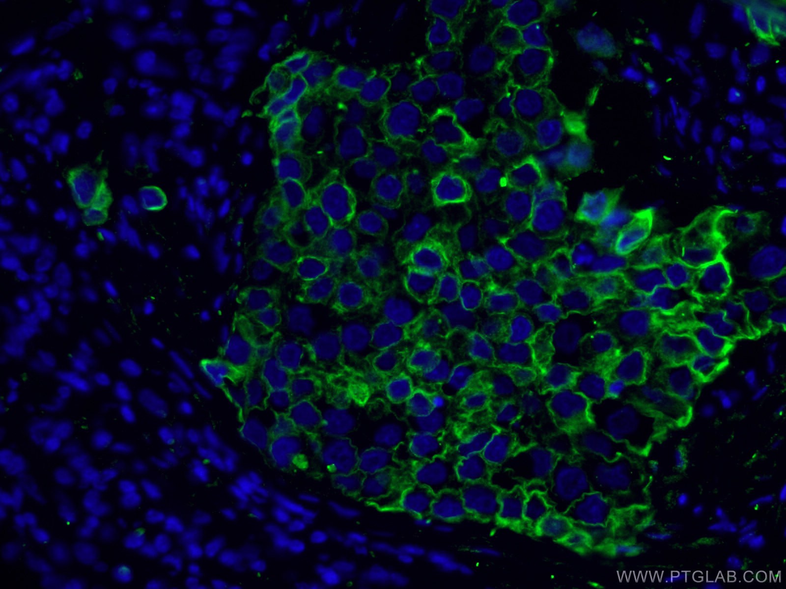 Immunofluorescence (IF) / fluorescent staining of human breast cancer tissue using Cytokeratin 8 Polyclonal antibody (10384-1-AP)
