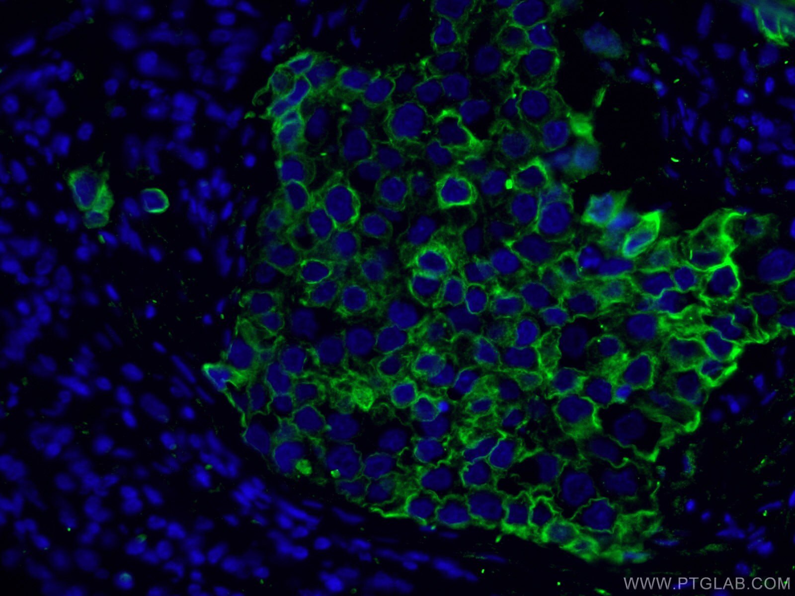 Immunofluorescence (IF) / fluorescent staining of human breast cancer tissue using Cytokeratin 8 Polyclonal antibody (10384-1-AP)