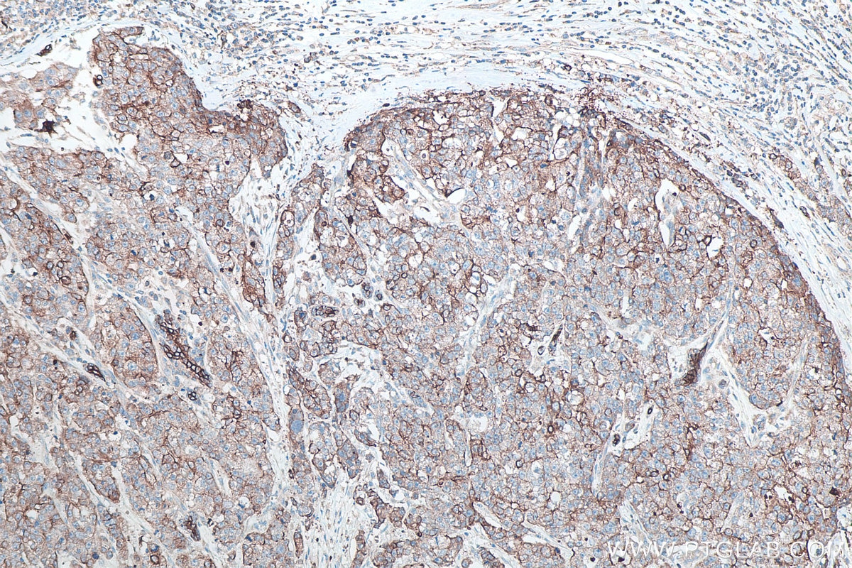 Immunohistochemistry (IHC) staining of human breast cancer tissue using Cytokeratin 8 Polyclonal antibody (10384-1-AP)