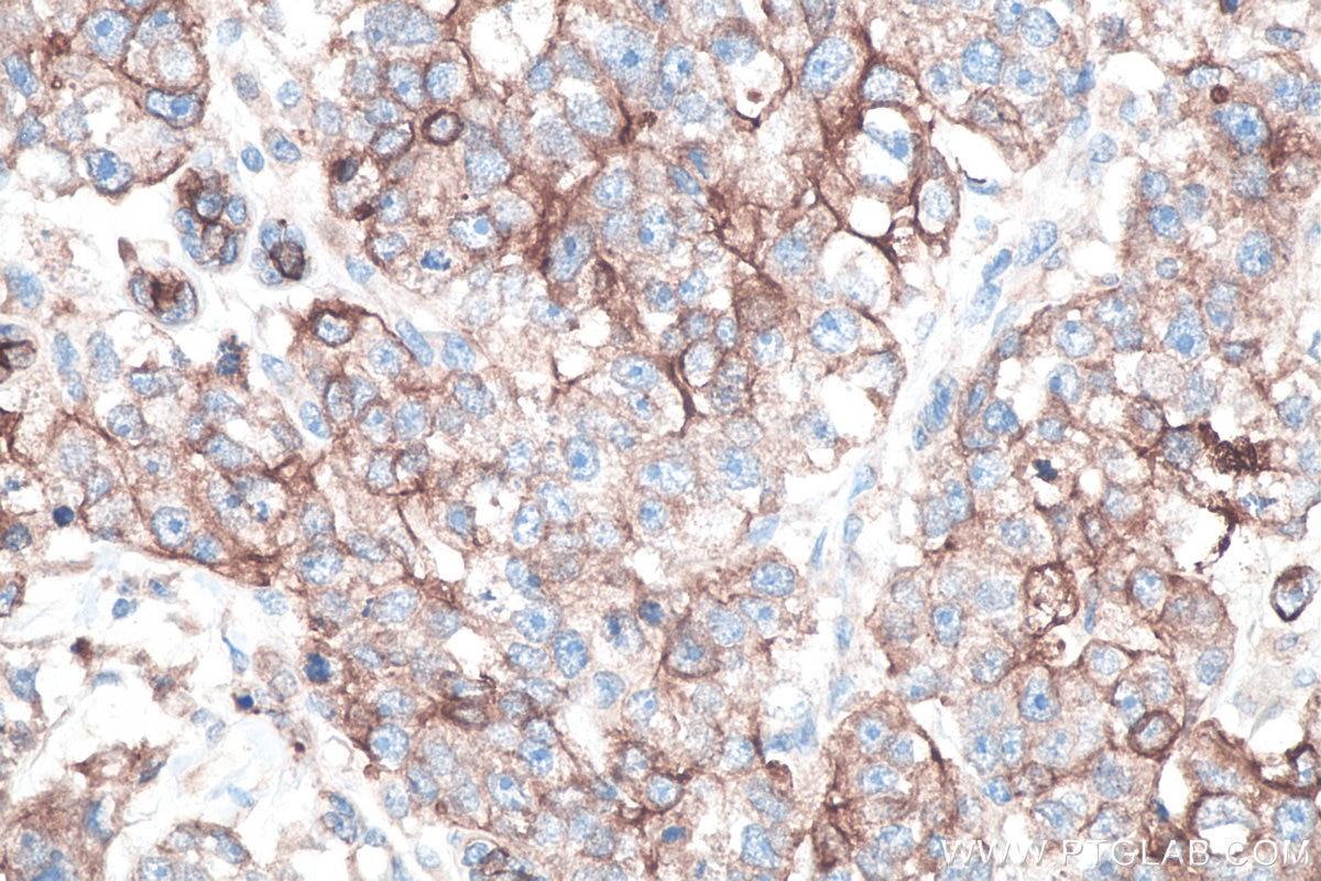 Immunohistochemistry (IHC) staining of human breast cancer tissue using Cytokeratin 8 Polyclonal antibody (10384-1-AP)