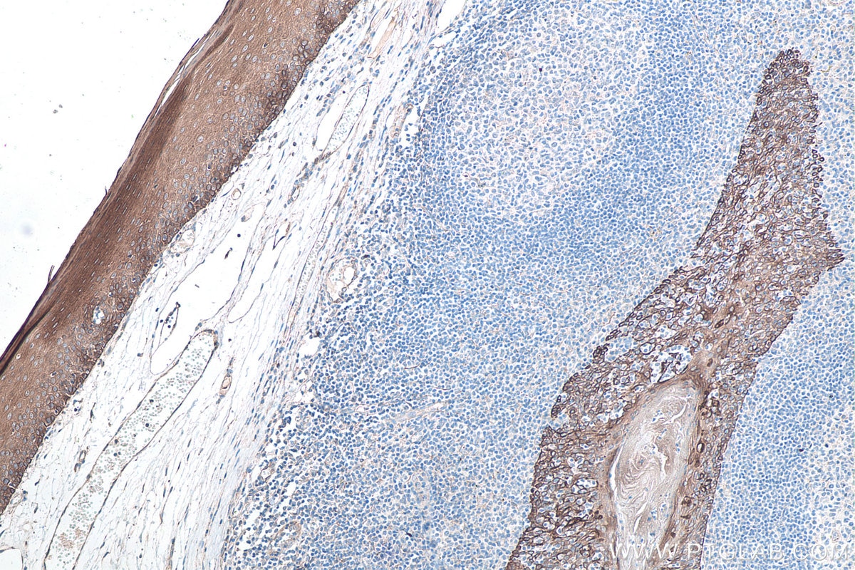 Immunohistochemistry (IHC) staining of human tonsillitis tissue using Cytokeratin 8 Polyclonal antibody (10384-1-AP)